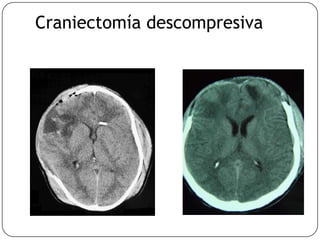 Craniectomía descompresiva
 