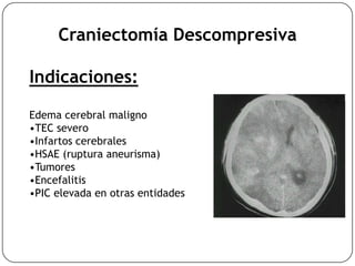Craniectomía Descompresiva
Indicaciones:
Edema cerebral maligno
•TEC severo
•Infartos cerebrales
•HSAE (ruptura aneurisma)
•Tumores
•Encefalitis
•PIC elevada en otras entidades
 