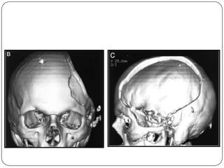 Hemicraniectomia
 