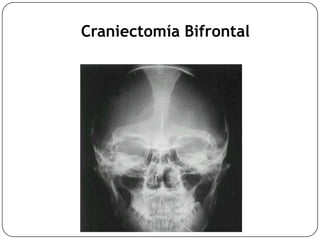 Craniectomía Bifrontal
 