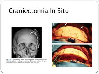 Craniectomia In Situ
 