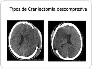 Tipos de Craniectomía descompresiva
 