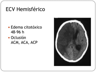 ECV Hemisférico
 Edema citotóxico
48-96 h
 Oclusión
ACM, ACA, ACP
 