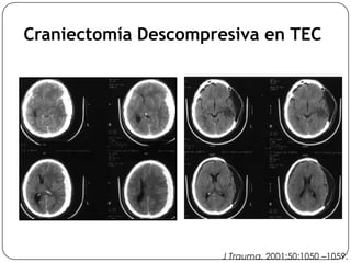 Craniectomía Descompresiva en TEC
J Trauma. 2001;50:1050 –1059.
 