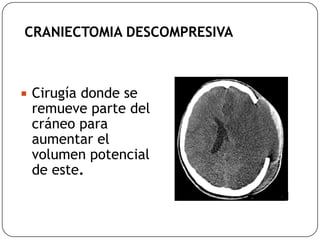 CRANIECTOMIA DESCOMPRESIVA
 Cirugía donde se
remueve parte del
cráneo para
aumentar el
volumen potencial
de este.
 