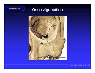 Prof. Peter Reher, CD, MSc, PhD
Prof. Peter Reher, CD, MSc, PhD
Osso zigom
Osso zigomá
ático
tico
Acidentes
Acidentes
SOBOTTA J. Atlas de Anatomia Humana.
SOBOTTA J. Atlas de Anatomia Humana.
20 ed Guanabara
20 ed Guanabara Koogan
Koogan, 1995
, 1995.
.
 