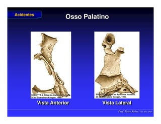 Prof. Peter Reher, CD, MSc, PhD
Prof. Peter Reher, CD, MSc, PhD
Osso Palatino
Osso Palatino
Vista Anterior Vista Lateral
Vista Anterior Vista Lateral
Acidentes
Acidentes
SOBOTTA J. Atlas de Anatomia Humana.
SOBOTTA J. Atlas de Anatomia Humana.
20 ed Guanabara
20 ed Guanabara Koogan
Koogan, 1995
, 1995.
.
SOBOTTA J. Atlas de Anatomia Humana.
SOBOTTA J. Atlas de Anatomia Humana.
20 ed Guanabara
20 ed Guanabara Koogan
Koogan, 1995
, 1995.
.
 