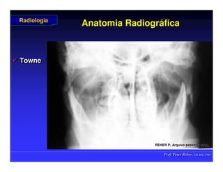 Prof. Peter Reher, CD, MSc, PhD
Prof. Peter Reher, CD, MSc, PhD
Anatomia Radiogr
Anatomia Radiográ
áfica
fica
 Towne

 Towne
Towne
Radiologia
Radiologia
REHER P
REHER P.
. Arquivo
Arquivo pessoal
pessoal, 2006.
, 2006.
 