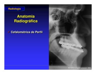 Prof. Peter Reher, CD, MSc, PhD
Prof. Peter Reher, CD, MSc, PhD
Anatomia
Anatomia
Radiogr
Radiográ
áfica
fica
 Cefalométrica de Perfil

 Cefalom
Cefalomé
étrica
trica de Perfil
de Perfil
Radiologia
Radiologia
REHER P
REHER P.
. Arquivo
Arquivo pessoal
pessoal, 2006.
, 2006.
 