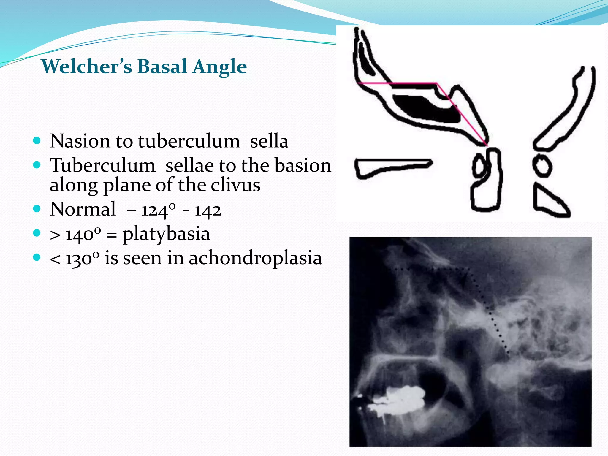 Cranio Vertebral Anomalies Overview PPTX cranio-vertebral-anomalies-overview-pptx