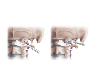 At a higher magnification, the C2 nerve root is seen crossing
the vertebral artery (VA).
 