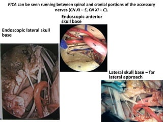 11th nerve behind left vertebral artery at cervico-medullary junction – listen
lecture at 23.25 min in this Prof. Amin Kassam video
https://www.youtube.com/watch?v=QoMCqwJ6Ke0
Through anterior skull base
approach
Through endoscopic lateral skull
base approach – The entrance of
the vertebral artery is the
boundary between the foramen
magnum and the spinal part of
the accessory nerve.
 