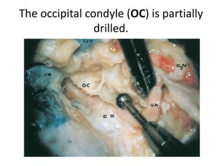 The accessory nerve (XI) is closely related to the vertebral artery (VA) at the point of
dural entrance. Note the dura attached to the artery at this level.
Endoscopic lateral skull base
approach
 