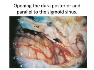 intra operative photograph
through operating
microscope during removal
of posterior fossa
arachnoid cyst -showing
medulla oblnagata-cervical
spinal cord -cerebellar
tonsils-vertebral artery-
hypoglossal nerve -
accessory nerve -1st
cervical nerve root -PICA
loope,after removal of cyst
wall
 