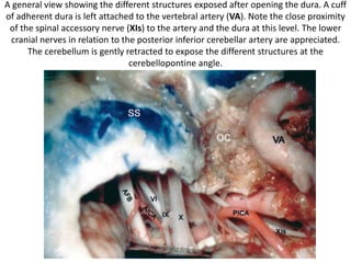 The accessory nerve (XI) is closely related to the vertebral artery (VA) at the
point of dural entrance. Note the dura attached to the artery at this level.
In far lateral approach
 
