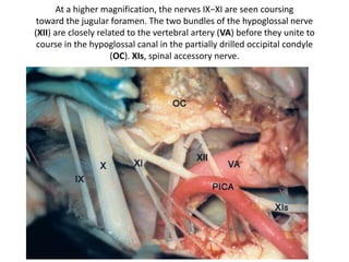 The segment of the vertebral artery located between the C1 transverse
process and the dural entrance gives rise to muscular branches and the
posterior meningeal artery, which can be safely coagulated. The PICA
ocasionally arises extradural and could be inadvertently injured.
 