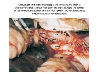 The PICA
ocasionally arises
extradural and
could be
inadvertently
injured – see the
total material
regarding this
topic at
http://neuroc99.sl
d.cu/text/Microsu
rgicalPICA.htm
 