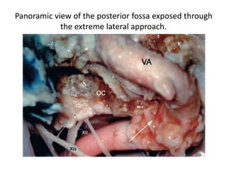 The PICA ocasionally arises extradural and could be inadvertently
injured – see the total material regarding this topic at
http://neuroc99.sld.cu/text/MicrosurgicalPICA.htm
 