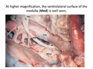 Although the dural opening is performed after drilling of the occipital condyle, it has been
opened before to expose the neurovascular structures. The hypoglossal nerve arises from the
preolivar sulcus and runs laterally to the hypoglossal canal. From this view, the hypoglossal
nerve is covered by the roots of the accesory nerve.
The posterior condylar emissary vein, which travels from the jugular bulb to the extradural
venous plexus, may be injured and hemostasis, if it is necessary. The degree of occipital
condyle removal vary widely, although posterior and medial one third of the condyle usually is
enough for ventrolateral tumors. If more than 50% of the condyle is resected, the
craniovertevral junction becomes unstable, and occipitocervical stabilization is required.
 