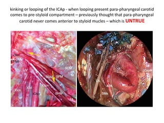 Lower clivus + petrous bone [ base ]
Petrous
bone
devided
into three
1/3rds
 