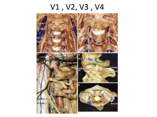 PICA can be seen running between spinal and cranial portions of the accessory
nerves (CN XI – S, CN XI – C).
Endoscopic lateral skull
base
Endoscopic anterior
skull base
Lateral skull base – far
lateral approach
 