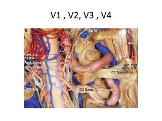 Opening the dura posterior and
parallel to the sigmoid sinus.
 