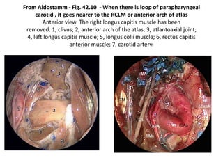 Lower clivus + petrous bone [ base ] + Zygomatic bone
Petrous bone devided
into three 1/3rds
 