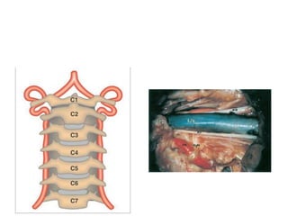 At a higher magnification, the nerves IX−XI are seen coursing
toward the jugular foramen. The two bundles of the hypoglossal nerve
(XII) are closely related to the vertebral artery (VA) before they unite to
course in the hypoglossal canal in the partially drilled occipital condyle
(OC). XIs, spinal accessory nerve.
 