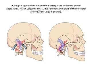 Panoramic view of the posterior fossa exposed through
the extreme lateral approach.
 