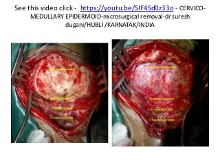 See this video click - https://youtu.be/SIF4Sd0z33o - CERVICO-
MEDULLARY EPIDERMOID-microsurgical removal-dr suresh
dugani/HUBLI /KARNATAK/INDIA
 