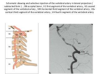 Schematic drawing and selective injection of the vertebral artery in lateral projection (
subtracted form ) , OB occipital bone , V1 first segment of the vertebral artery , V2 second
segment of the vertebral artery , V3h horizontal third segment of the vertebral artery , V3v
vertical third segment of the vertebral artery , V4 fourth segment of the vertebral artery
 