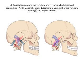 A. Surgical approach to the vertebral artery – pre and retrosigmoid
approaches. (ⓒ Dr. Laligam Sekhar). B. Saphenous vein graft of the vertebral
artery (ⓒ Dr. Laligam Sekhar).
 