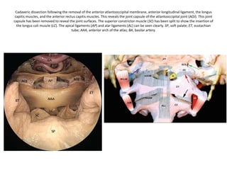 Vetebral venous plexus
 