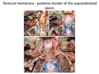 The VAs pass through the transverse foramina of the first six vertebrae and exit from the transverse foramen
of C1, running backward and medially over the posterior arch of C1, and pierce the posterior atlanto-
occipital membrane and the spinal dura. They are surrounded extracranially by a venous plexus that does
not enter the intradural space.
CP sympathetic carotid plexus, C1 atlas, C1TP transverse process of C1, ICAp parapharyngeal
portion of the internal carotid artery, IJV internal jugular vein, LCapM longus capitis muscle, Ma
mastoid (tip), OC occipital condyle, RCAM rectus capitis anterior muscle, SCG superior cervical
ganglion, SP styloid process, VA vertebral artery, VVP vertebral venous plexus, ZR zygomatic
root, XIIcn hypoglossal nerve, yellow arrow vagus nerve, red arrow accessory nerve, black arrow
glossopharyngeal nerve, white asterisk middle meningeal artery
The extradural segment of VA gives rise to posterior meningeal and posterior spinal arteries and branches
to the deep cervical muscles.
 