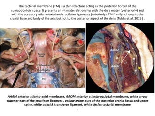Cadaveric dissection following the removal of the mucosa and pharyngobasilar fascia. The middle third of
the clivus has been removed to reveal the pons. The longus capitis (LC) muscles insert broadly onto the floor
of the sphenoid sinus (removed in this specimen). The pharyngeal raphe (PR) can be seen attaching to the
pharyngeal tubercle (PT) of the occipital bone. ET, eustachian tube; BA, basilar artery; PCA, paraclival artery.
 