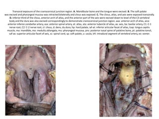 Cadaveric dissection following the removal of the anterior atlantooccipital membrane, anterior longitudinal ligament, the longus
capitis muscles, and the anterior rectus capitis muscles. This reveals the joint capsule of the atlantooccipital joint (AOJ). This joint
capsule has been removed to reveal the joint surfaces. The superior constrictor muscle (SC) has been split to show the insertion of
the longus coli muscle (LC). The apical ligaments (AP) and alar ligaments (AL) can be seen clearly. SP, soft palate; ET, eustachian
tube; AAA, anterior arch of the atlas; BA, basilar artery.
 
