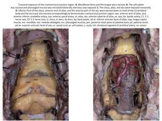 AAAM anterior atlanto-axial membrane, AAOM anterior atlanto-occipital membrane, AIM
anterior intertransversarius muscle, AL alar ligament, ALL anterior longitudinal ligament, Cl
clivus, C1 atlas, C1TP transverse process of C1, C2 axis, D dens, JF jugular foramen, OC occipital
condyle, PT pharyngeal tubercle, RCLM rectus capitis lateralis muscle, SCG supracondylar
groove, SP styloid process, VA vertebral artery, blue-sky arrow apical ligament, white arrow
superior part of the cruciform ligament, green arrow external ori fi ce of hypoglossal canal, black
arrow atlantoaxial joint, red arrow atlanto-occipital joint, blue arrow lateral atlanto-occipital
ligament, yellow arrow dura of the posterior cranial fossa and upper spine, white asterisk transverse
ligament, white circles tectorial membrane
 