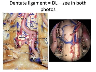 The tectorial membrane (TM) is a thin structure acting as the posterior border of the
supraodontoid space. It presents an intimate relationship with the dura mater (posteriorly) and
with the accessory atlanto-axial and cruciform ligaments (anteriorly). TM fi rmly adheres to the
cranial base and body of the axis but not to the posterior aspect of the dens (Tubbs et al. 2011 ) .
AAAM anterior atlanto-axial membrane, AAOM anterior atlanto-occipital membrane, white arrow
superior part of the cruciform ligament , yellow arrow dura of the posterior cranial fossa and upper
spine, white asterisk transverse ligament, white circles tectorial membrane
.
 