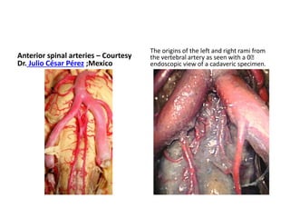 Transoral exposure of the craniocervical junction region. A. Mandibular bone and the tongue were excised. B. The soft palate
was excised and pharyngeal mucosa was retracted bilaterally and clivus was exposed. C. The clivus, atlas, and axis were exposed transorally.
D. Inferior third of the clivus, anterior arch of atlas, and the anterior part of the axis were excised down to level of the C3 vertebral
body and the dura was also excised correspondingly to demonstrate craniocervical junction region. aaa: anterior arch of atlas, aica:
anterior inferior cerebellar artery, asa: anterior spinal artery, at: atlas, ata: anterior tubercle of atlas, ax: axis, ba: basilar artery, C1: C-1
nerve root, C2: C-2 nerve root, cl: clivus, d: dens, du:dura, hp: hard palate, iaf-at: inferior articular facet of atlas, lcap: longus capitis
muscle, ma: mandible, mo: medulla oblangata, mu: pharyngeal mucosa, pns: posterior nasal spine of palatine bone, pt: palatine tonsil,
saf-ax: superior articular facet of axis, sc: spinal cord, sp: soft palate, u: uvula, V4: intradural segment of vertebral artery, vo: vomer.
 
