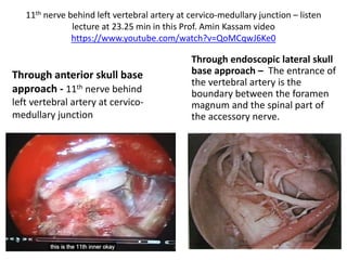 Dentate ligament = DL – see in both
photos
 