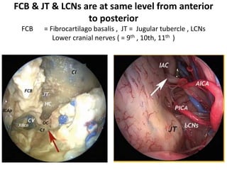 Anterior spinal arteries – Courtesy
Dr. Julio César Pérez ;Mexico
The origins of the left and right rami from
the vertebral artery as seen with a 0􀀤
endoscopic view of a cadaveric specimen.
 