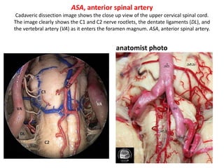 PSA & ASA
With a more downward angulation of the
microscope, the upper part of the spinal
cord (SpC) is well controlled. The posterior
spinal artery (PSA) is also seen.
Anterior spinal arteries – Courtesy
Dr. Julio César Pérez ;Mexico
 