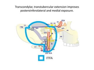 Intracranial hypoglossal region. Anterior endoscopic transnasal-transclival vision is
compared with a posterior retrosigmoid endoscopic one
JF jugular foramen, JT jugular tubercle, IO inferior olive, PICA posteroinferior cerebellar artery, VA vertebral artery, IXcn
glossopharygeal nerve, Xcn vagus nerve, XIcnCR cervical roots of accessory nerve, XIcnSR spinal roots of accessory nerve,
XIIcn hypoglossal nerve
Cranial nerves IX and X present a close relationship with the fi rst portion of the PICA. They are protected by the arachnoid
membrane (Roche et al. 2008 ) . The roots of cranial nerve XIcn from the spine pass through the foramen magnum posterior
to the vertebral artery. Within the hypoglossal canal, XIIcn is surrounded by a venous plexus and dural and arachnoid
sheets. Branches of the ascending pharyngeal artery coursing through the hypoglossal canal are seen in about 50 % of cases
(Lang 1995 ) . Also branches from the posterior meningeal artery have been described (Janfaza and Nadol 2001 ). The
transcisternal vein to the area of the JF can be seen. Also, veins to the hypoglossal canal can be present. The hypoglossal
nerve do not exit with VA. It can have maximum 3 outlets. On the contrary, C1 roots exit with the VA.
 