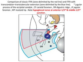 FCB & JT & LCNs are at same level from anterior
to posterior
FCB = Fibrocartilago basalis , JT = Jugular tubercle , LCNs
Lower cranial nerves ( = 9th , 10th, 11th )
 