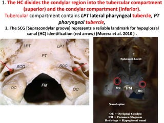 1. The HC divides the condylar region into the tubercular compartment
(superior) and the condylar compartment (inferior).
Tubercular compartment contains LPT lateral pharyngeal tubercle, PT
pharyngeal tubercle,
2. The SCG [Supracondylar groove] represents a reliable landmark for hypoglossal
canal (HC) identification (red arrow) (Morera et al. 2010 ) .
 