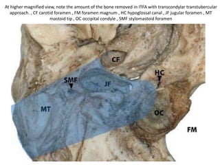 From Laterally
1. Far lateral or Transcondylar approach
2. ITFA with Transcondylar Transtubercular approach
(ITF-A + TC + TT approach)
3. Modified trans-cochlear approach type D (MTCD)
 