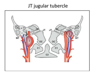 From Laterally
2. ITFA with Transcondylar Transtubercular approach
(ITF-A + TC + TT approach)
 