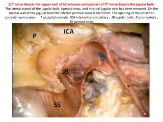 Transcondylar, transtubercular extension improves
posteroinferolateral and medial exposure.
 