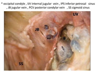 Comparison of classic ITFA (zone delimited by the red line) and ITFA with
transcondylar–transtubercular extension (zone delimited by the blue line). * jugular
process of the occipital condyle , CF carotid foramen , DR digastric ridge , JF jugular
foramen , MT mastoid tip . Note hypoglossal nerve at anterior 1/3rd & middle 1/3rd
junction .
 