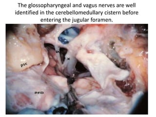 Inferior view of skull base, comparison of classic ITFA of Fisch and modified ITFA with transcondylar–
transtubercular extension. In addition to removal of bone in classic ITFA of Fisch, drilling of the jugular
process of the occipital bone and even some of the occipital condyle facilitates control of the area of the
jugular bulb. Yellow dashed line: classic ITFA of Fisch. Blue dashed line: modified ITFA with transcondylar–
transtubercular extension. CF carotid foramen , DR digastric ridge , FL foramen lacerum , FO foramen ovale ,
JF jugular foramen , JP jugular process of the occipital bone , MT mastoid tip , OC occipital condyle , Arrow
stylomastoid foramen
 